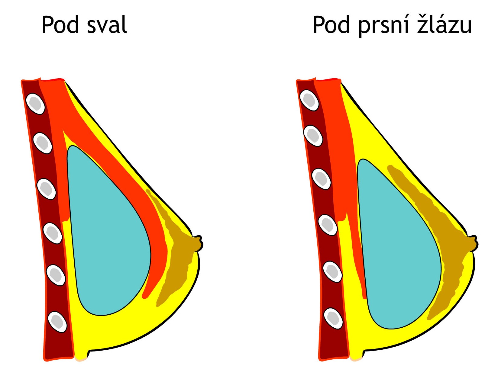 Uložení prsních implantátů