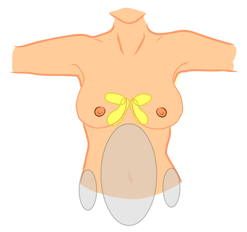 Augmentace s liposukcí