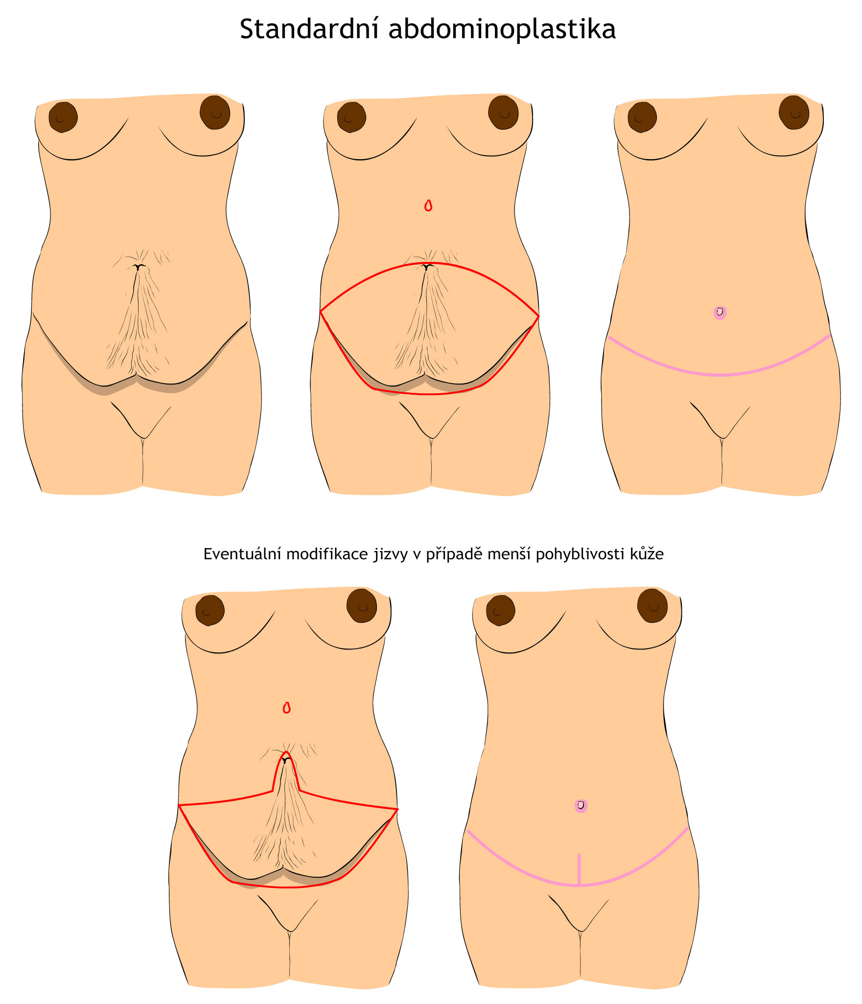 Standardní abdominoplastika