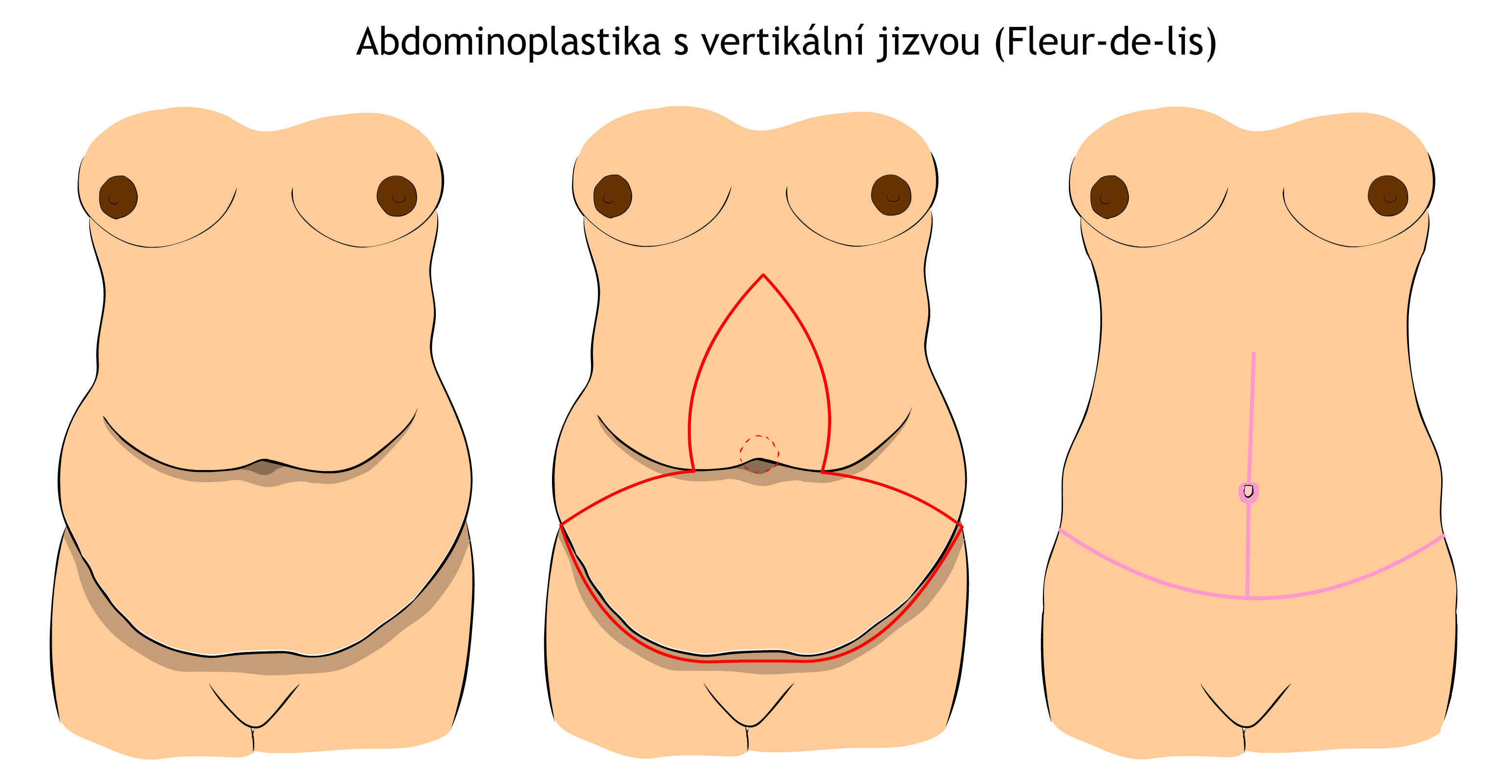 Fleur-de-lis abdominoplastika