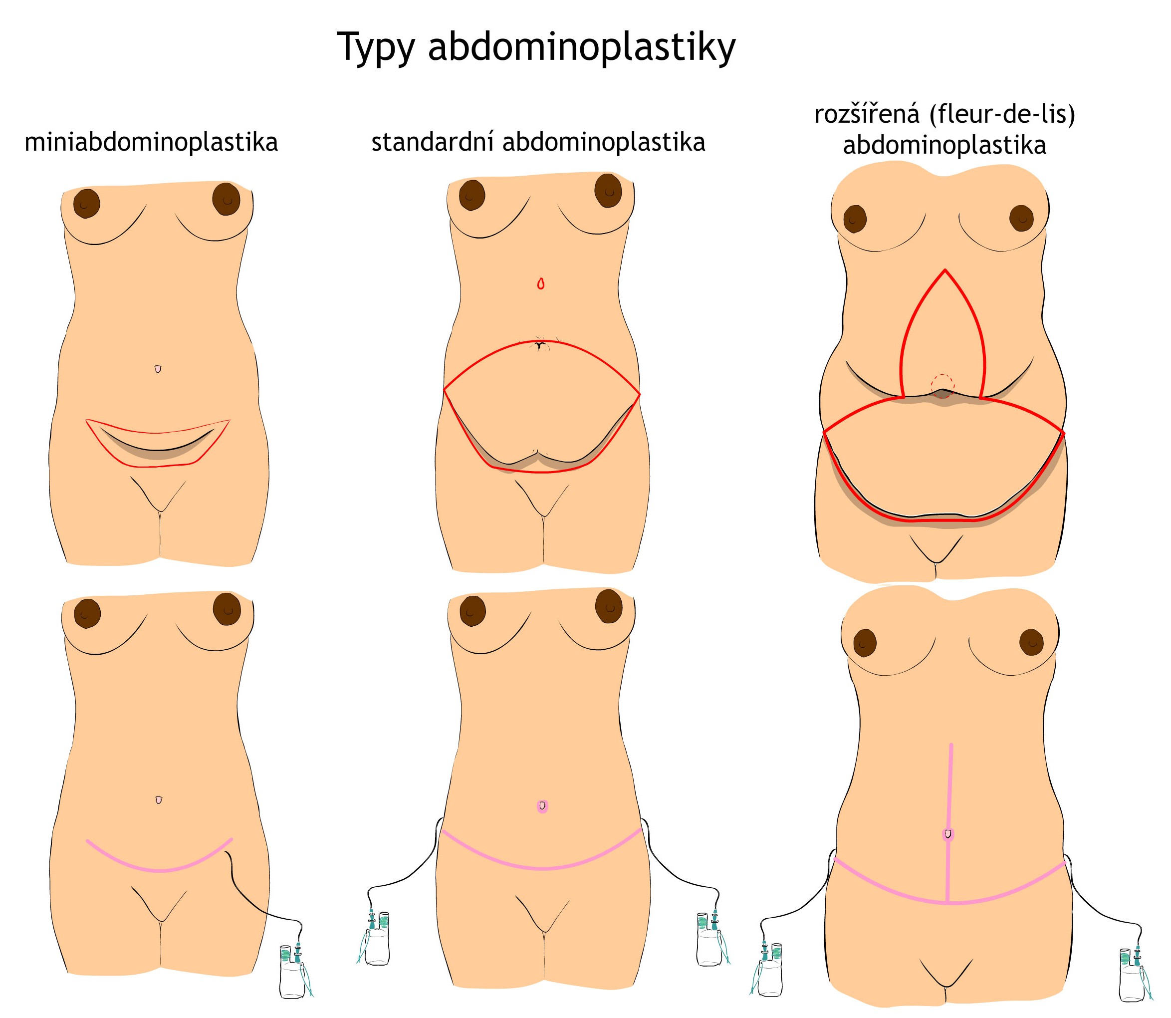 Miniabdominoplastika