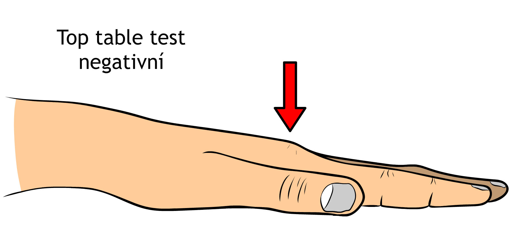 Dupuytrenova kontraktura table top test
