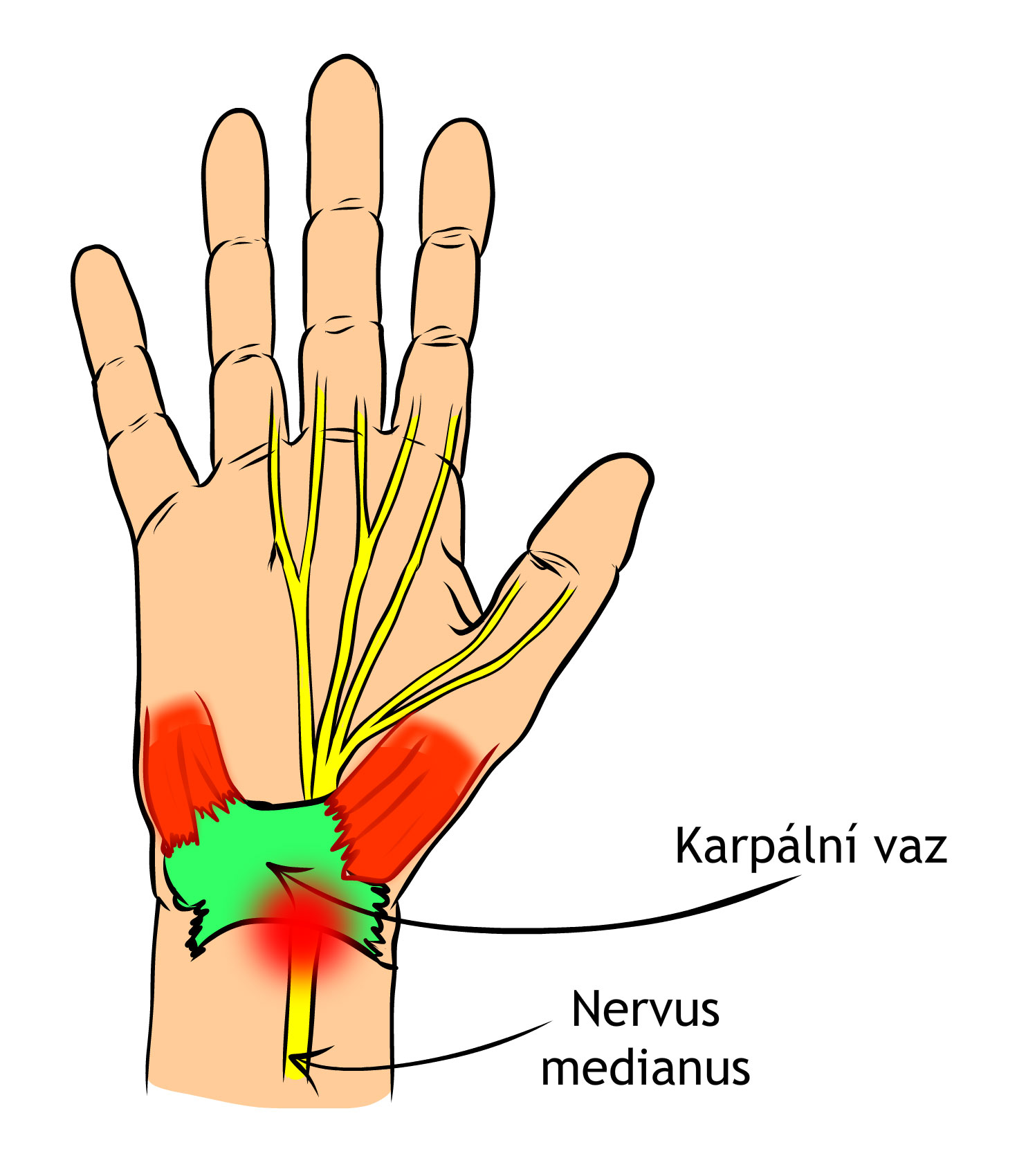Syndrom karpálního tunelu
