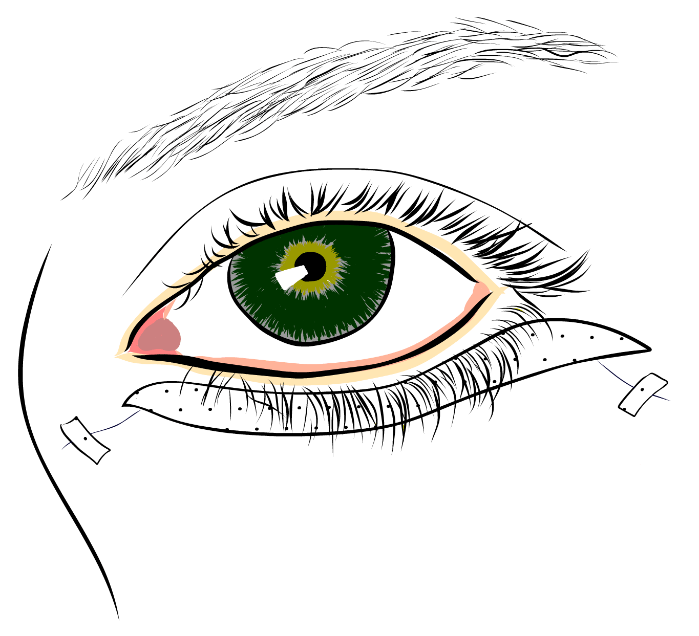 Operace dolních víček - náplasti