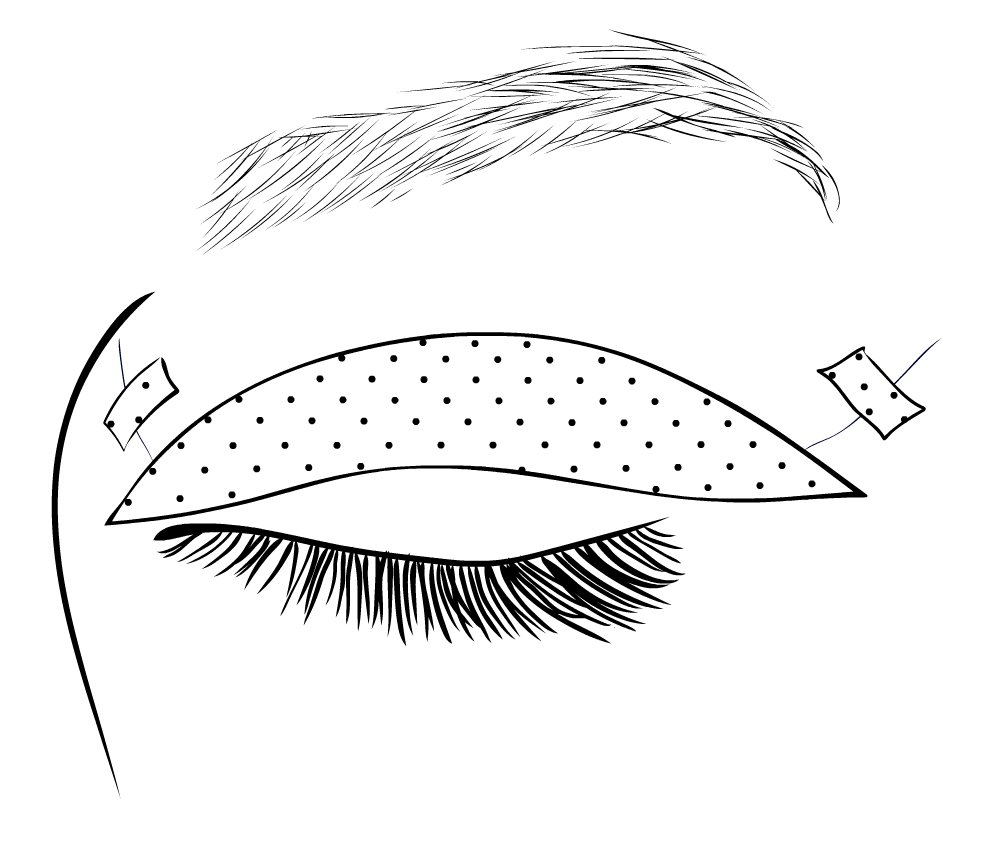 Operace horních víček - náplasti