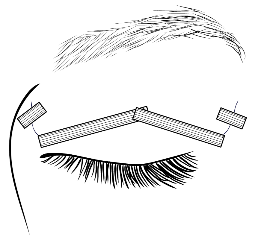 Operace horních víček - náplasti