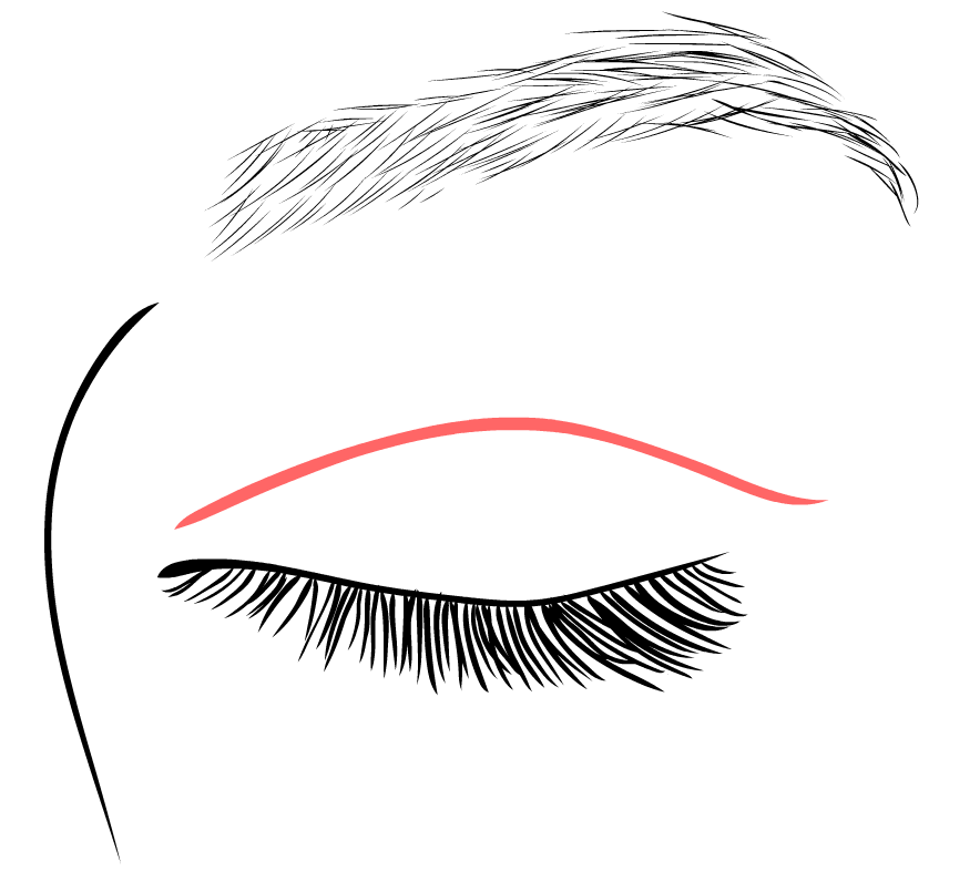 Operace horních víček - jizva