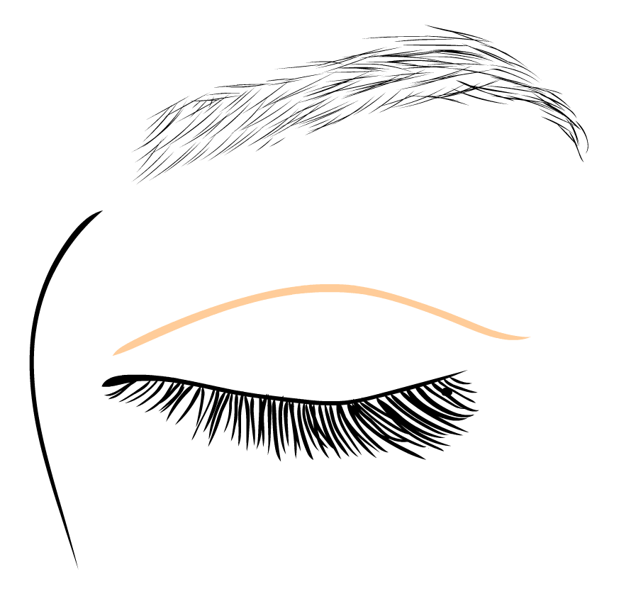 Operace horních víček - jizva