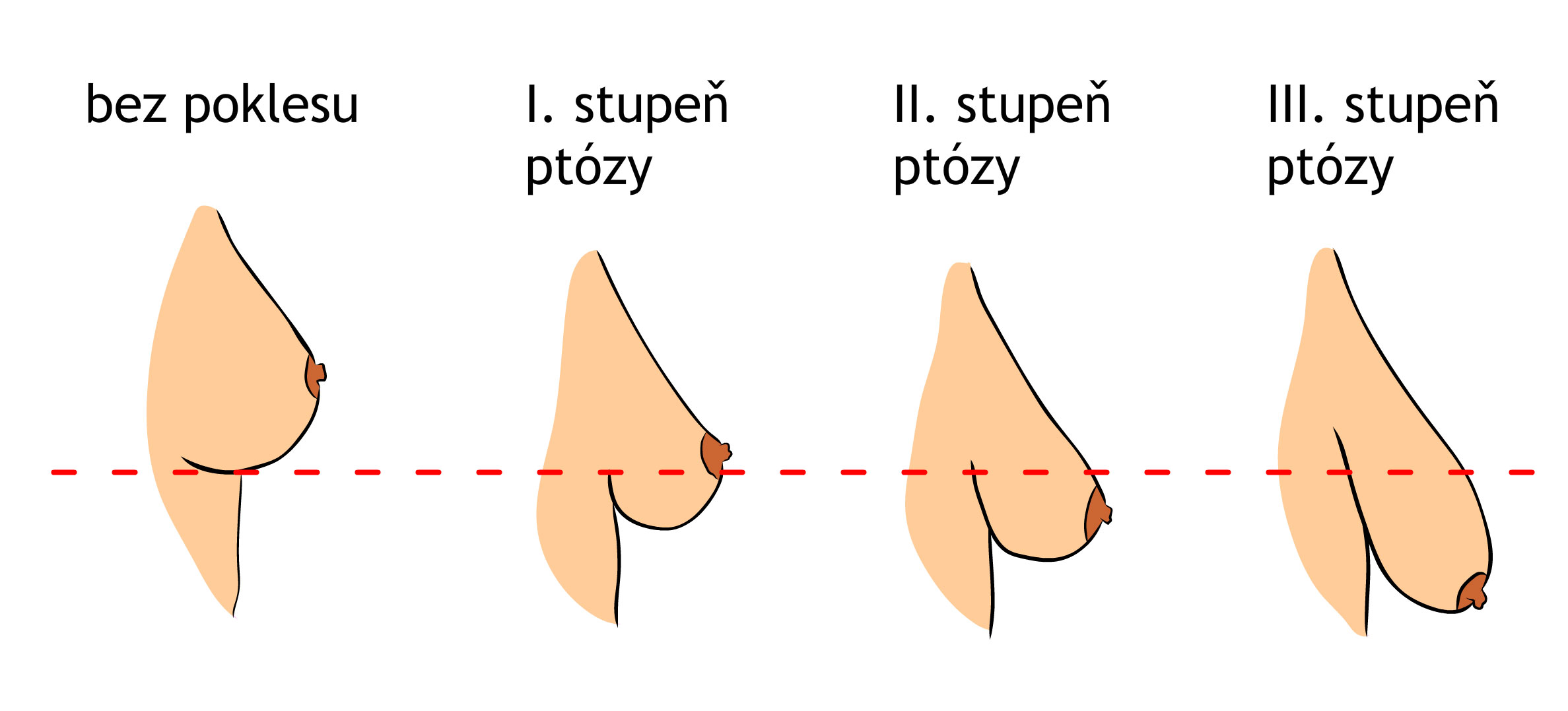 schéma hypertrofie prsů a ptózy prsů