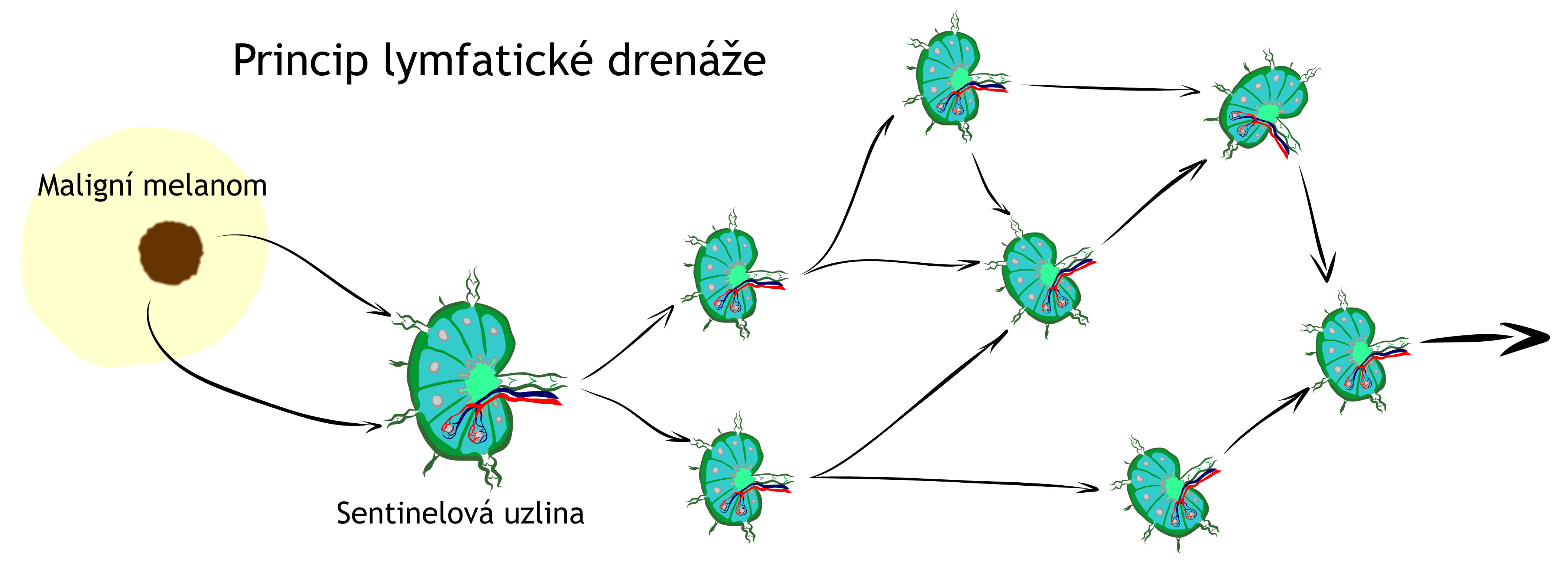 Princip lymfatické drenáže u maligního melanomu
