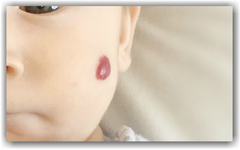 Hemangiom u dítěte