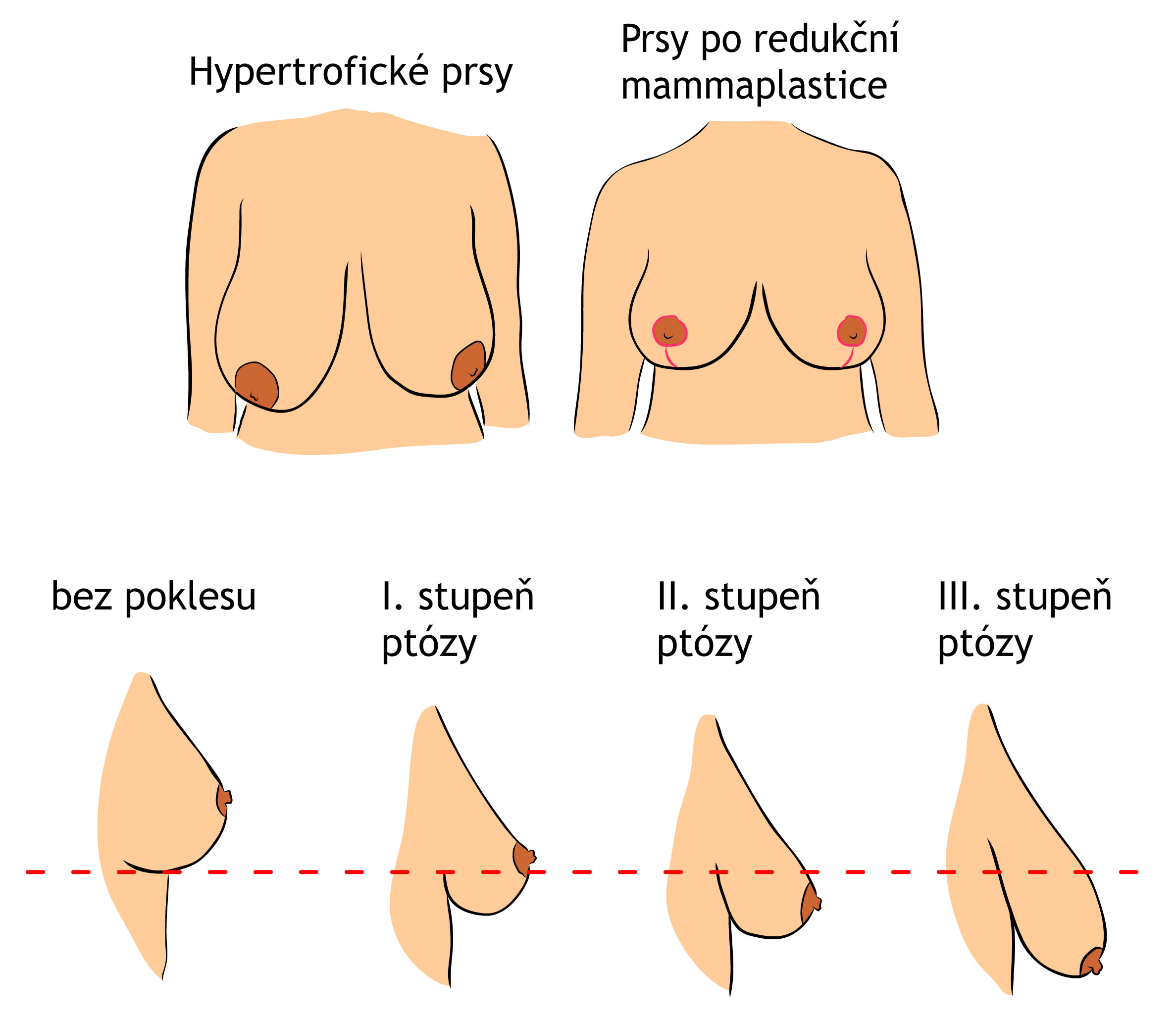 schéma hypertrofie prsů a ptózy prsů