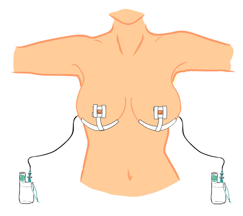 Zalepení ran a umístění drénů