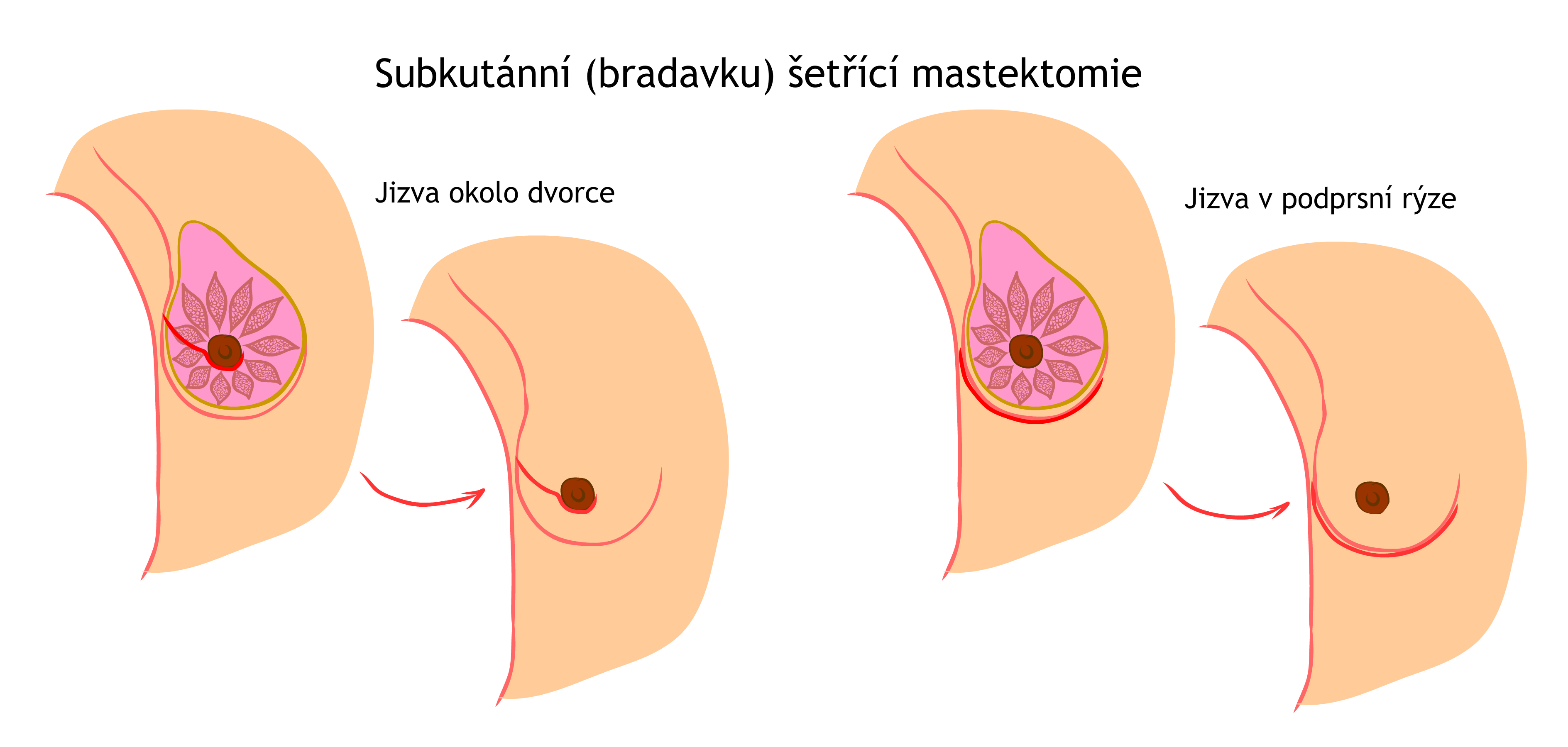 Subkutánní bradavku šetřící mastektomie