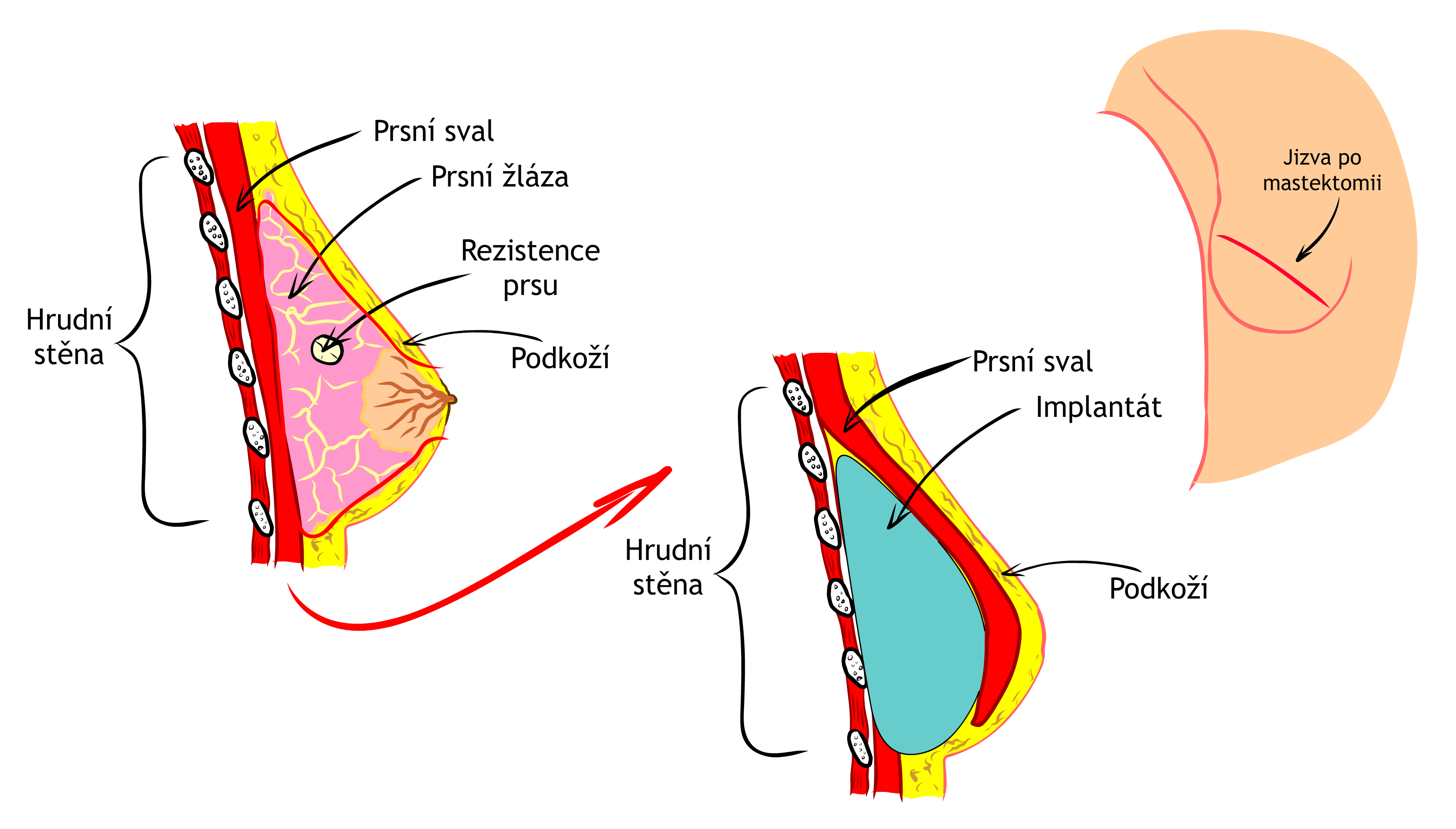 Rekonstrukce implantátem