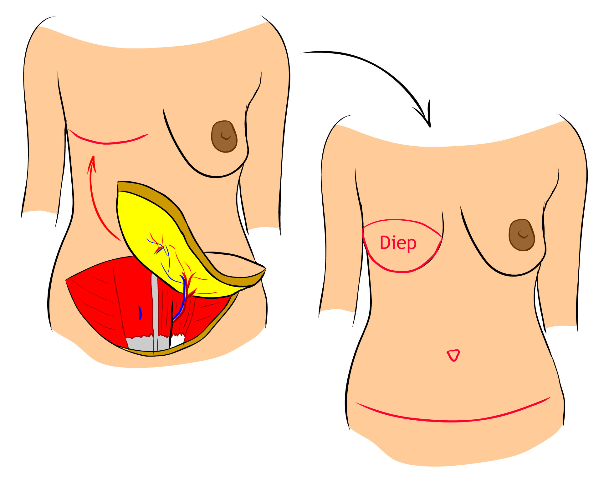 Rekonstrukce DIEP lalokem