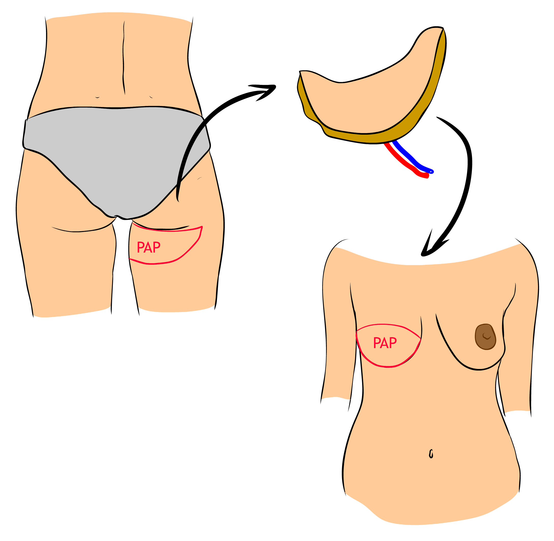 Rekonstrukce PAP lalokem
